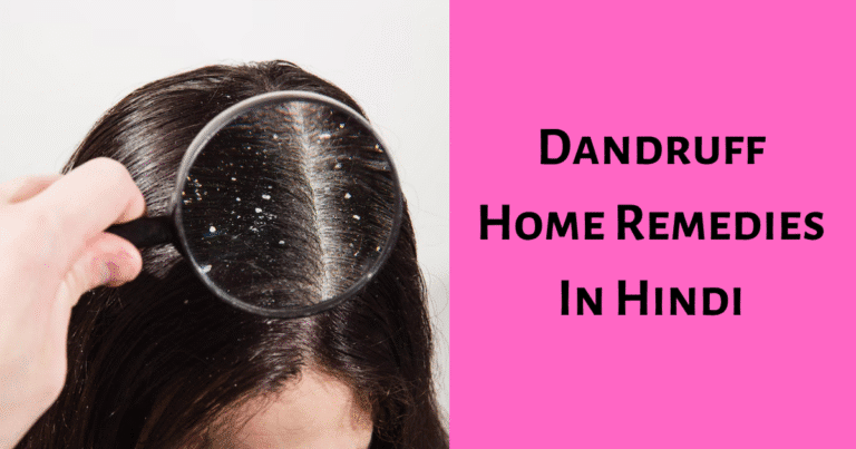 Dandruff Home Remedies in Hindi